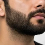 Injerto capilar de barba en Huelva - Clínica Frontela - Resultado natural con técnica FUE GOLD