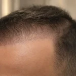 ¿Se cae el pelo después del injerto capilar? El shedding o caída del pelo trasplantado es un proceso normal tras el trasplante capilar en Clínica Frontela Huelva